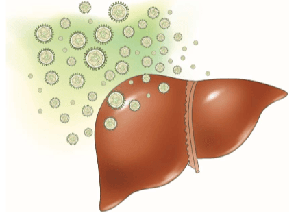 Hepatitis C- Symptoms, Complications, Risk Factors, Transmission and Treatment