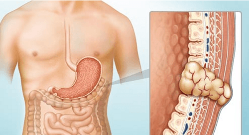 Risk Factors of GIST: Genetic Mutations that cause GI Tumors