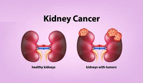 Kidney Cancer and its Treatments