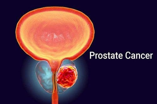 Prostate Cancer- A Treatable Health Condition among Men
