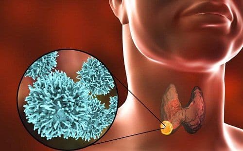 What are the common treatments for Thyroid Cancer?