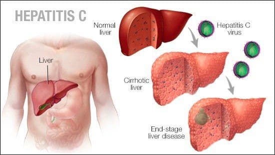 What is Hepatitis C and its Causes and Symptoms of the Infection?
