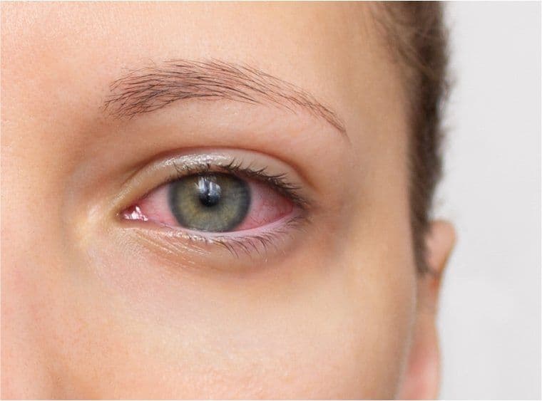 Myeloma and the Link to Ocular Manifestations