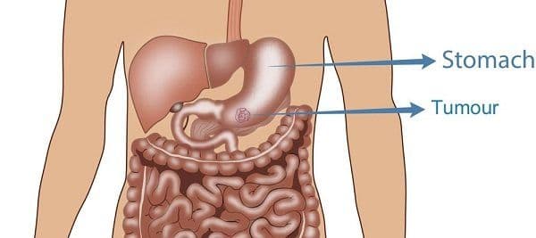 What is the Survival Rate of Gastrointestinal Stromal Tumors?