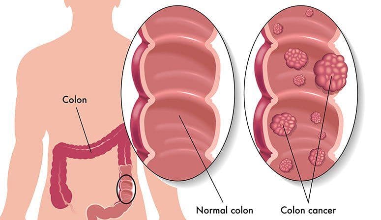 What Causes Colon Cancer in Females?