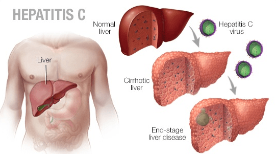 Is Hepatitis C Curable?