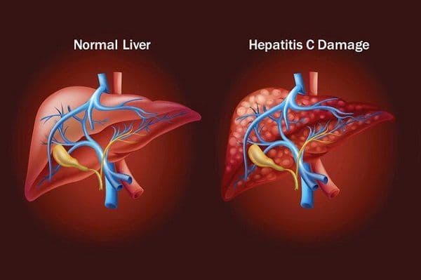 What are the Symptoms and Causes of Hepatitis C?