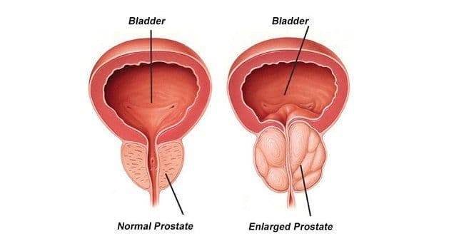 Prostate Cancer Symptoms and Treatment: What to Check for