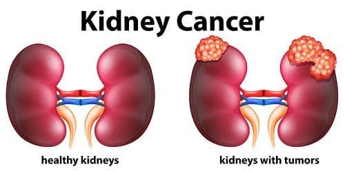 Overview of Cancers of Kidney, Liver and Thyroid