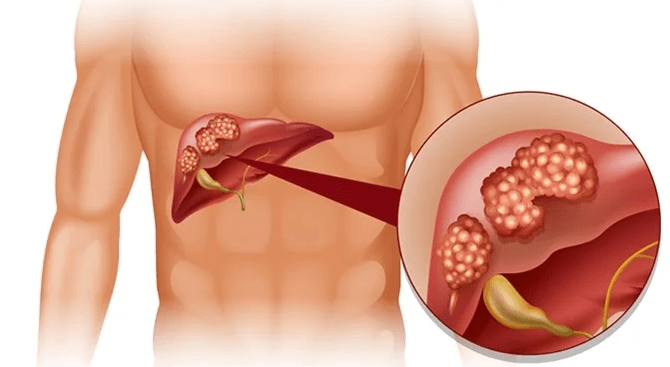 How Long can you Live with Liver Cancer?