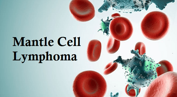 What is the Survival Rate of Mantle-Cell Lymphoma?