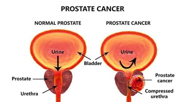 How to Prevent Prostate Cancer?