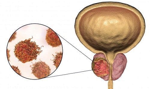 What does the Detection and Diagnosis of Prostate Cancer Entail?