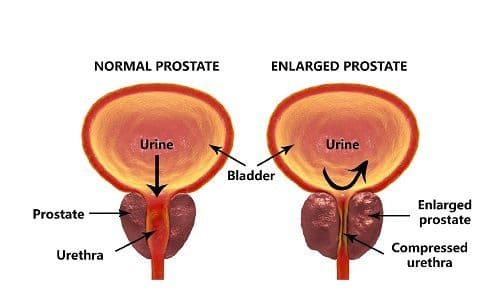 What is prostate cancer, and who falls in the high-risk factor category?