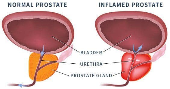 What are the 5 Common Warning Signs of Prostate Cancer?