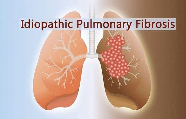 How do you get Idiopathic Pulmonary Fibrosis?
