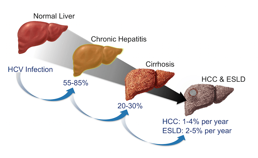 The Stages And Symptoms Of Hepatitis C Along With Its Treatment And Possible Side Effects