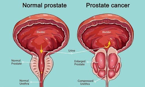 Prostate Cancer: Symptoms, Causes, Types and Treatment