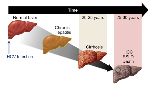How Sovihep can help treat chronic Hepatitis C?