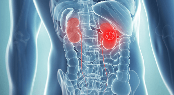 Epidemiology and Risk Factors for Kidney Cancer
