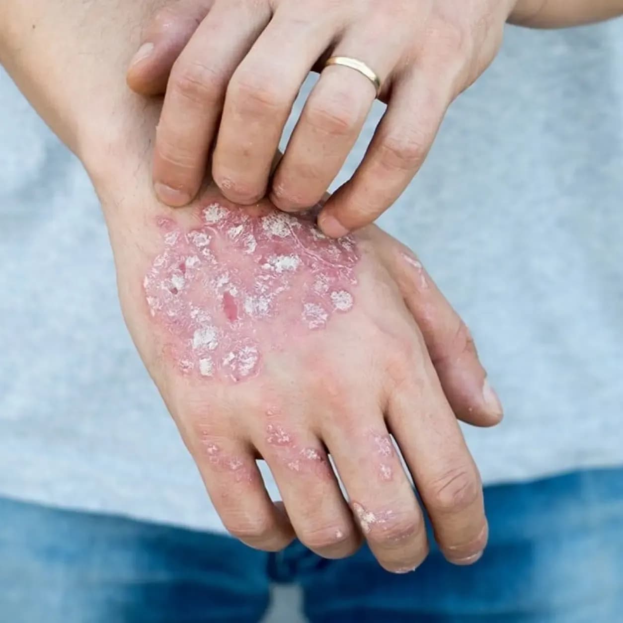 Plaque Psoriasis Medicine therapeutics research