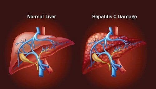 Dacihep – A helping aid towards hepatitis C virus