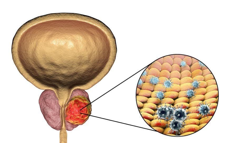 Frequently Asked Questions About Prostate Cancer