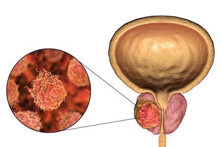 Beware of every Cancer! Even That of Prostate Gland