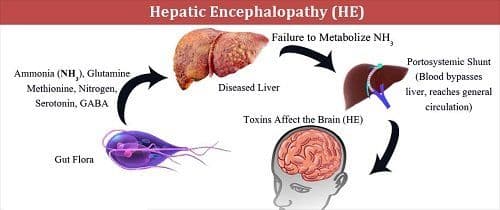 What is Hepatic Encephalopathy and What are its Symptoms?