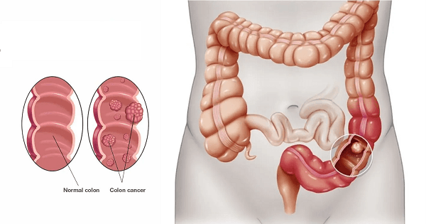 What is Colorectal Cancer, and How Does it Start?