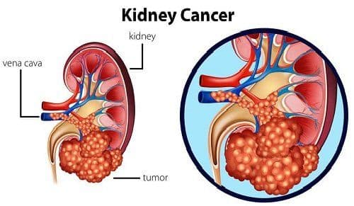 Take Lenvakast 4mg to treat Renal Cell Carcinoma