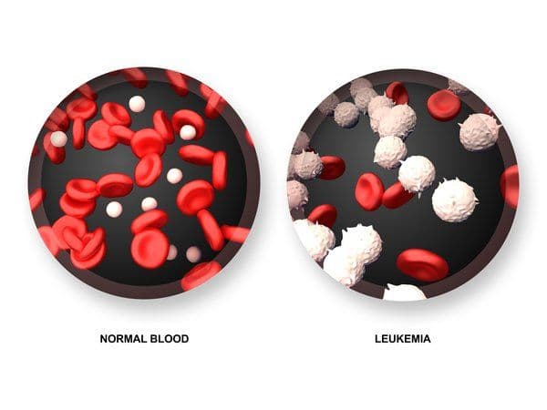 Different Treatment Options to Improve the Survival Rate of CML Leukemia?