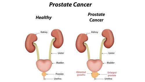 What are the Risk Factors and Symptoms of Prostate Cancer?