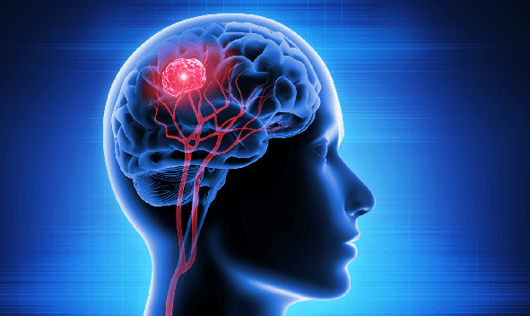 Are All Gliomas Malignant?