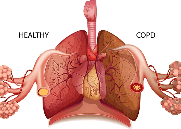 Symptoms of Chronic Obstructive Pulmonary Disorder