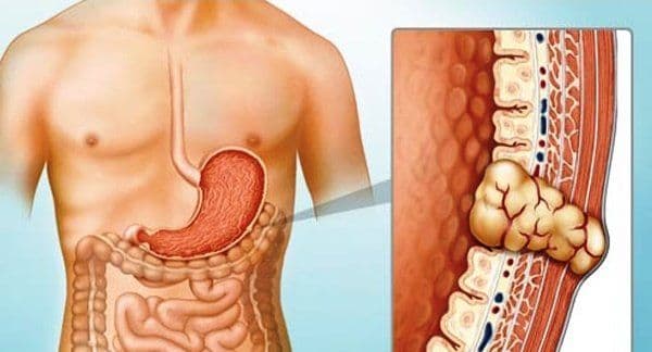 Is Gastrointestinal Stromal Tumor Curable?