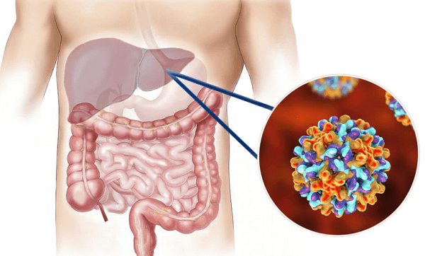 Hepatitis C: Symptoms, Dos and Don’ts, Causes & Treatment
