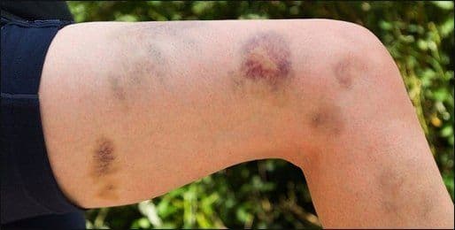 How to Manage Low Platelet Count due to ITP or HCV Infection?