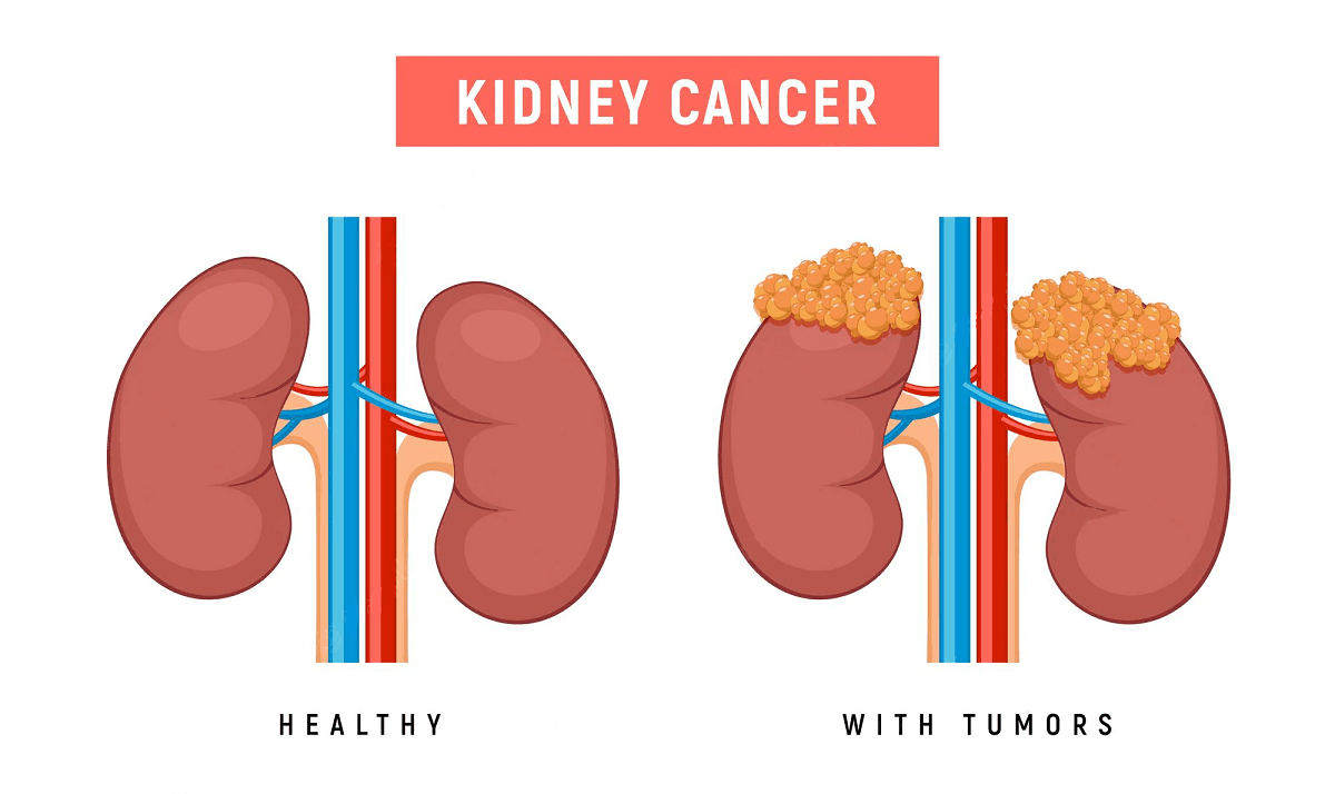 What are the Early Signs of Kidney Cancer?
