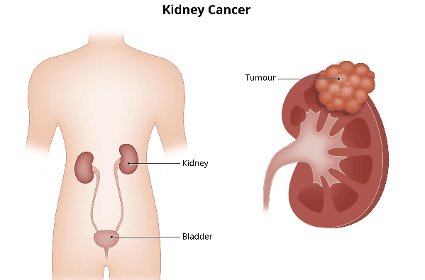 What are the First Signs of Kidney Cancer?
