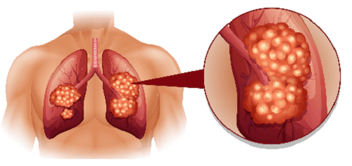 Small Cell vs Non-Small Cell Lung Cancer