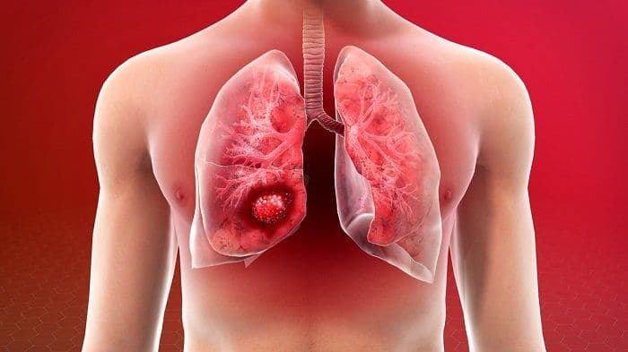 Idiopathic Pulmonary Fibrosis: Dissecting the Mystery