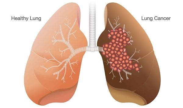 What is the Survival Rate of Non-Small Cell Lung Cancer?