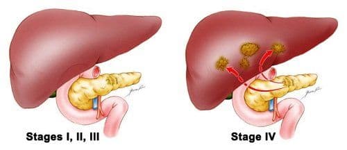 Erlotinib for Pancreatic and Lung Cancer: A first-line Treatment