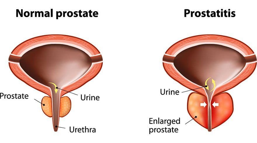 What are the Warning Signs of Prostate Cancer?