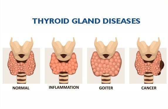 What are the Early Signs and Symptoms of Thyroid Cancer?