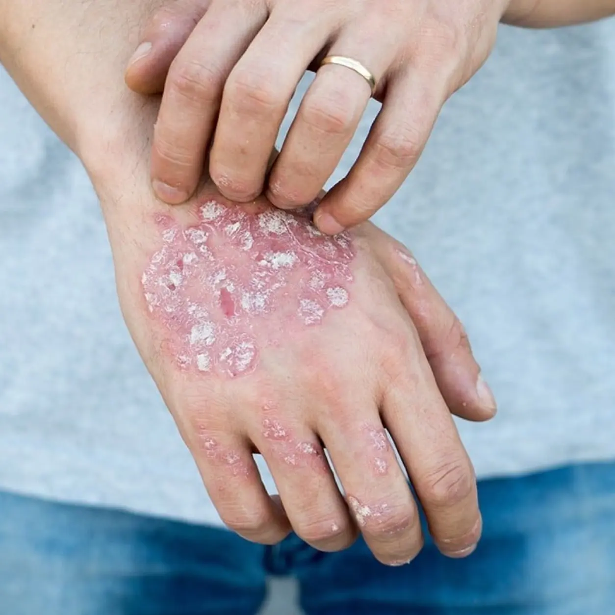 Plaque Psoriasis Medicine therapeutics research