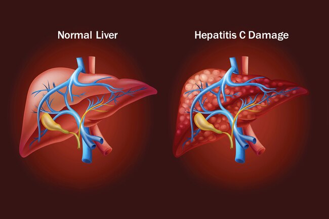 What is Hepatitis C? Symptoms and Treatment