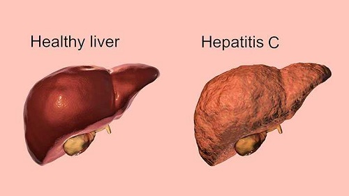 Hepatitis C