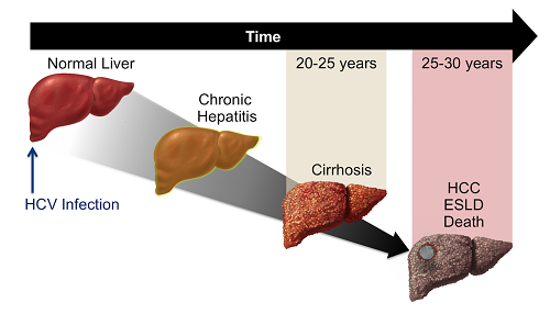 Treatment Of Chronic Hepatitis C Infection With The Help Of Sovihep